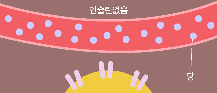 당뇨병의 종류 설명을 위한 이미지