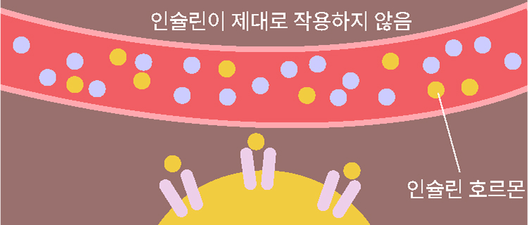 당뇨병의 종류 설명을 위한 이미지